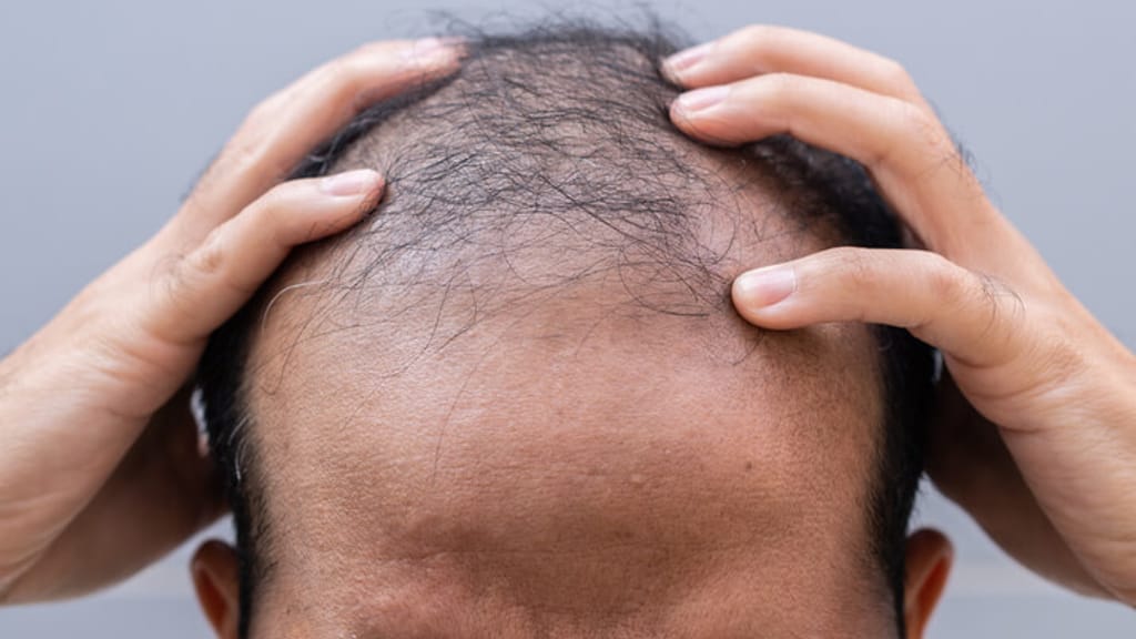 Wirkstoff durch Zufall entdeckt: Immunologe findet Mittel gegen Haarausfall - lifestyle - exxpress Nachrichten