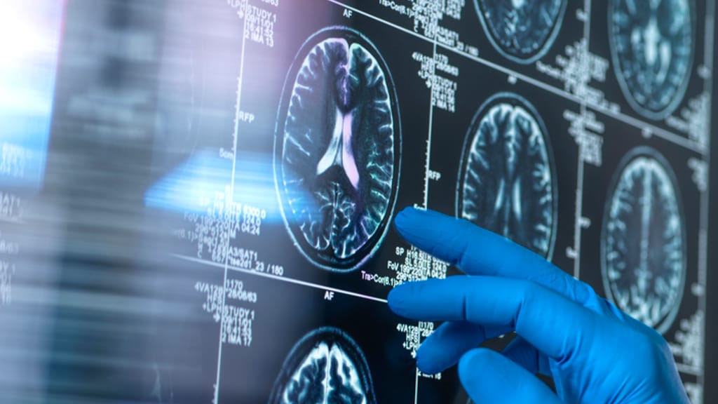 Neue Hoffnung gegen Alzheimer: Roche testet vorbeugenden Wirkstoff - economy - exxpress Nachrichten