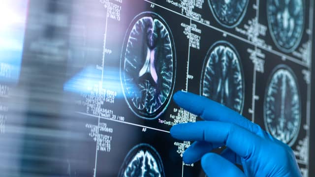 Neue Hoffnung gegen Alzheimer: Roche testet vorbeugenden Wirkstoff