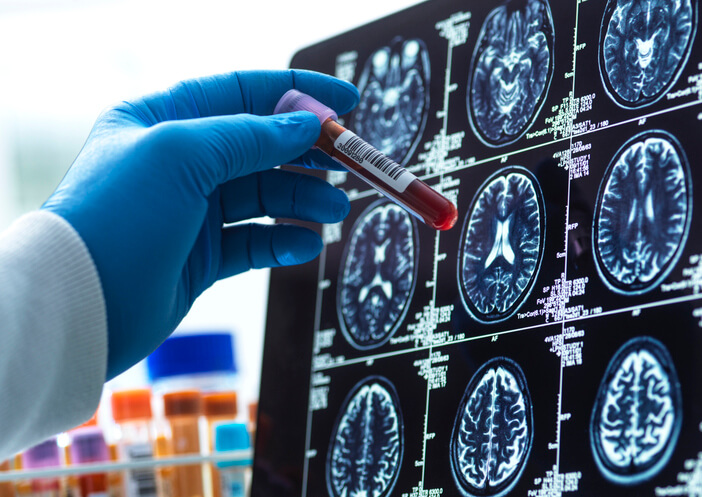 Roche Prejel Dve Evropski Dovoljenji za Zdravilo proti Raku in Test za Alzheimerjevo Bolezen